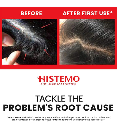 Histemo Anti-Dandruff & Oily Hair Kit, Scalp Cleanser, Shampoo, Conditioner & Hair Tonic, DHT Blocking Hair Restoration Treatment